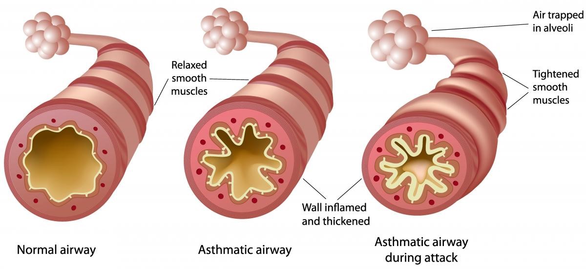 MA_asthma blog image MA_asthma blog image